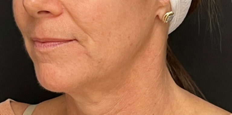 Before Image: Eurothread Lift - left-front-oblique