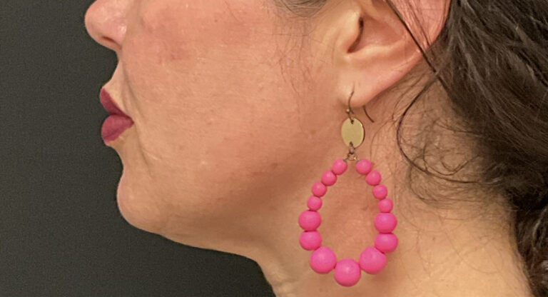 After Image: PDO Threads + Kybella - left-side